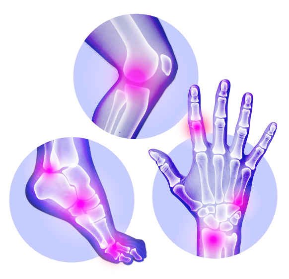 arthrite